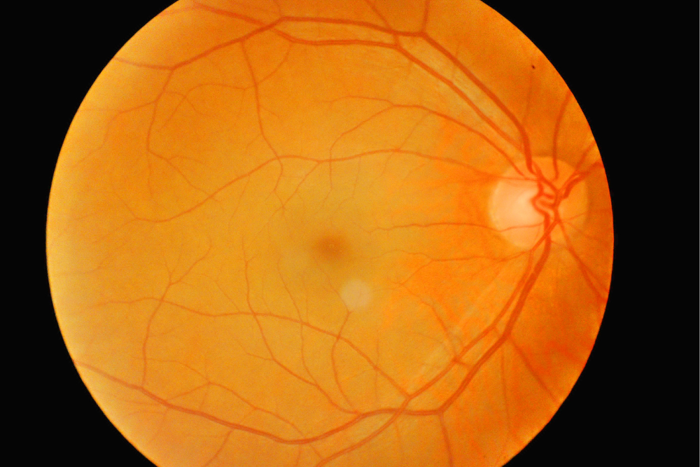 Aura Visiva Quando Sintomo Di Retinopatia Diabetica aura-visiva-quando-sintomo-di-retinopatia-diabetica