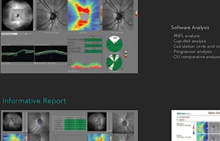 Glaucoma perché dopo i 60 anni una visita oculistica standard non basta