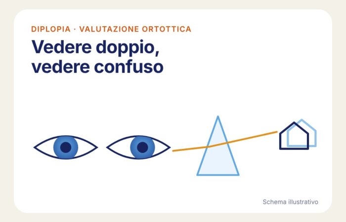 diplopia Schema illustrativo di due occhi e di una lente prismatica: diplopia e visione confusa